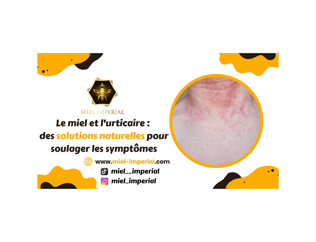 Le miel et l'urticaire : des solutions naturelles pour soulager les symptômes